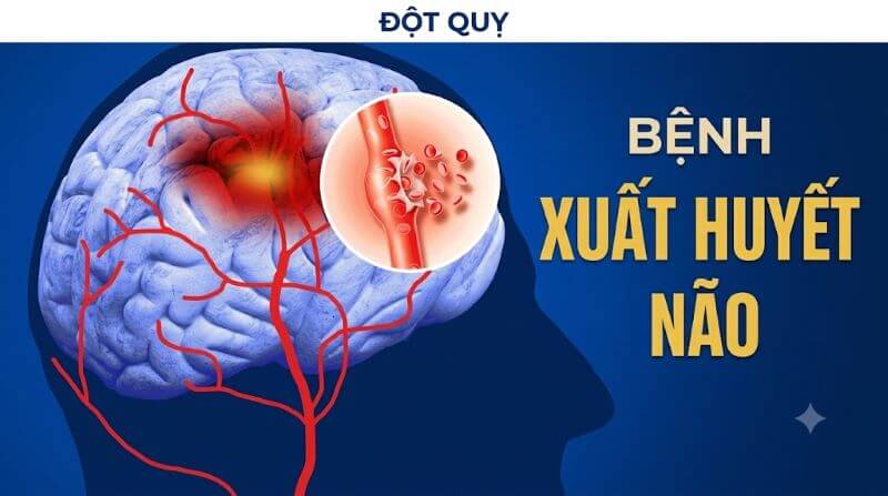 Đột quỵ do xuất huyết não